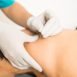 An individual undergoing dry needling therapy