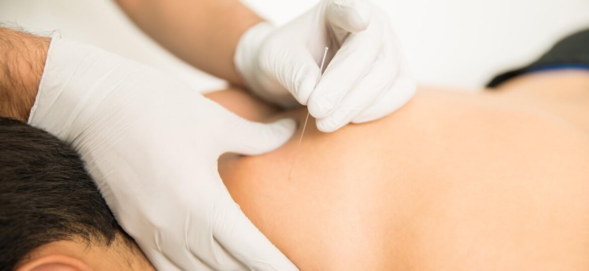 An individual undergoing dry needling therapy