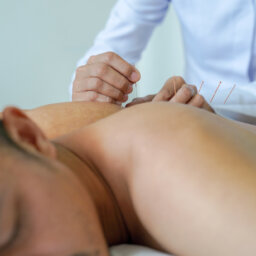 A young man undergoing dry needling therapy in El Paso