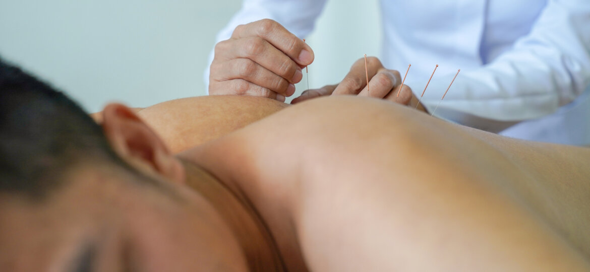 A young man undergoing dry needling therapy in El Paso