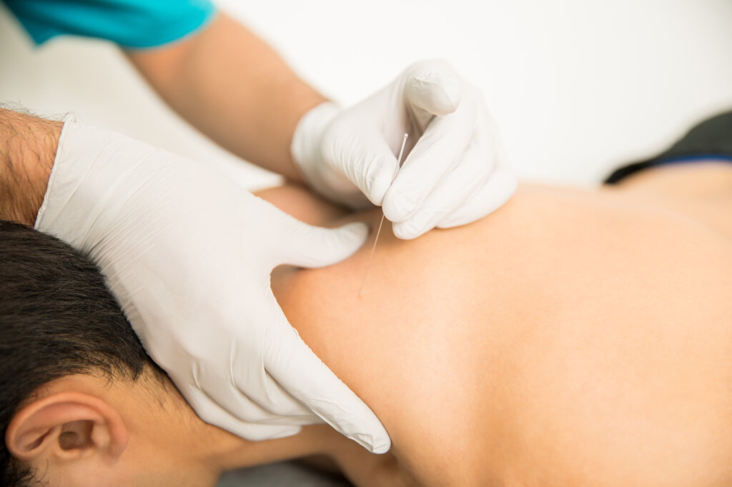 A physical therapist performing dry needling therapy on a patient’s neck.