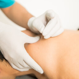 A physical therapist performing dry needling therapy on a patient’s neck.