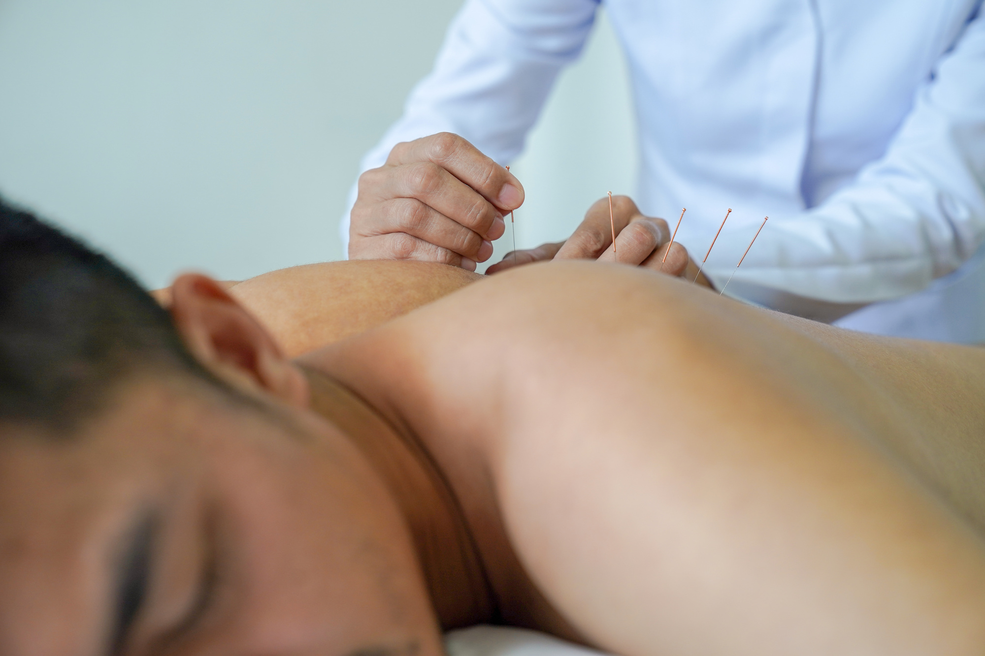 A young man undergoing dry needling therapy in El Paso